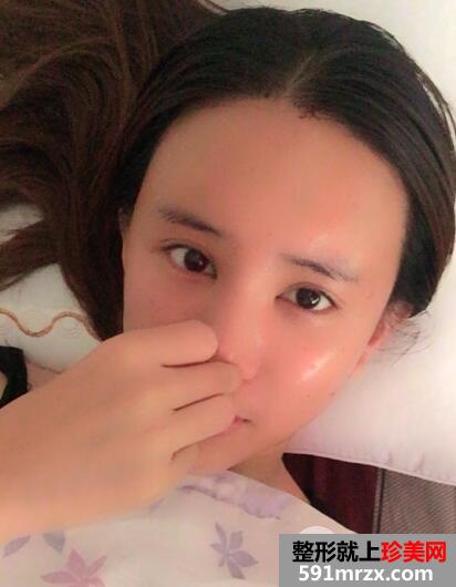 在北京禾美嘉整形脸部脂肪填充价格和4天图片案例