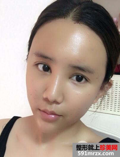 在北京禾美嘉整形脸部脂肪填充价格和4天图片案例