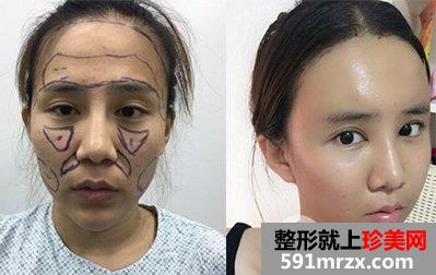 在北京禾美嘉整形脸部脂肪填充价格和4天图片案例