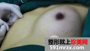 本人在北京禾美嘉自体丰胸手术价格和对比照片案例