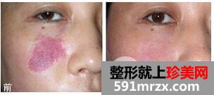 激光去胎记