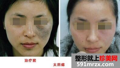激光去胎记
