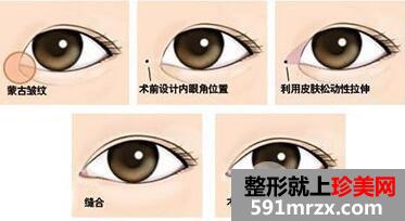 开眼角会出现红肿吗?