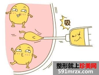 腰腹部吸脂一次可以吸多少脂肪?腰腹部吸脂的禁忌