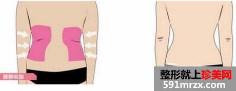 腰腹部吸脂一次可以吸多少脂肪?腰腹部吸脂的禁忌