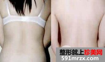 背部抽脂效果好吗？安全吗？多少钱？ 后背吸脂效果图