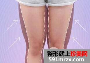大腿吸脂术后恢复需要多长时间？