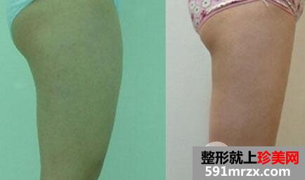 大腿吸脂后会凹凸不平吗?