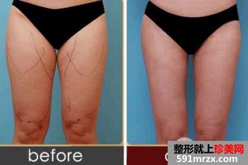大腿吸脂有年龄限制吗?大腿吸脂前后对比图