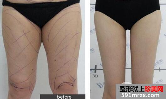 大腿吸脂有年龄限制吗?大腿吸脂前后对比图
