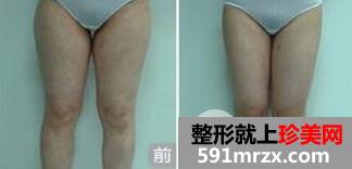 大腿吸脂会有疤痕吗？
