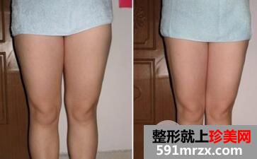 腿部吸脂会有后遗症吗?