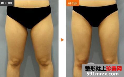 大腿吸脂术后该注意什么?
