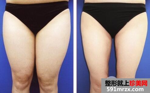 大腿吸脂之后要多久才能消肿？