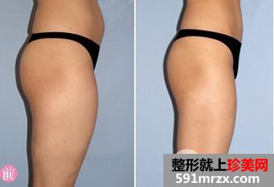 大腿吸脂术后会留疤吗？