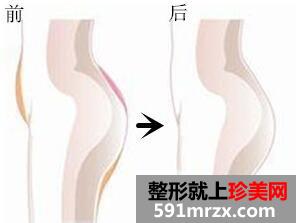 自体脂肪丰臀多少钱?利弊缺点?效果图