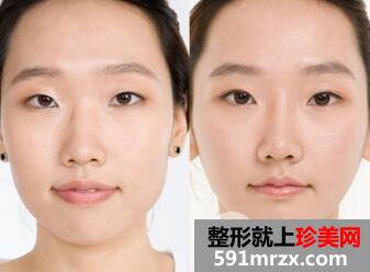 自体脂肪隆鼻后会发生移位吗？