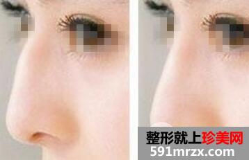 驼峰鼻效果图