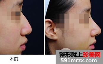 驼峰鼻该怎么矫正?