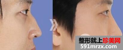 驼峰鼻矫正手术的方法有哪些