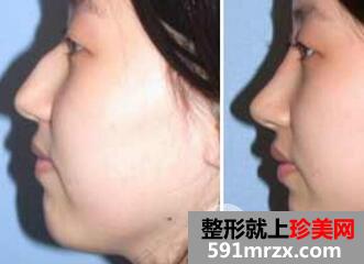 驼峰鼻效果图