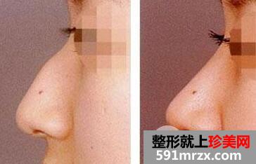 驼峰鼻矫正术恢复需要多少时间?