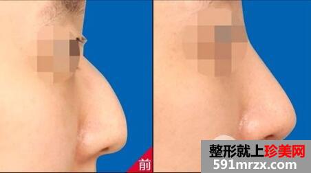 驼峰鼻要怎么矫正