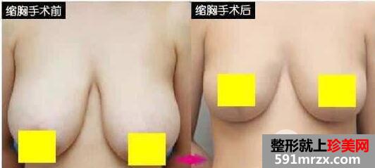 巨乳缩小多少钱?巨乳缩小术会影响哺乳吗?
