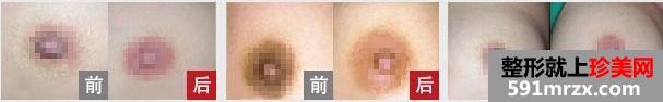 乳晕漂红做一次就行吗?效果怎么样？多少钱？