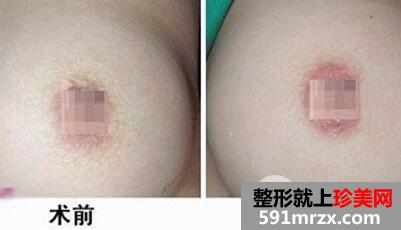 乳晕漂红做一次就行吗?效果怎么样？多少钱？