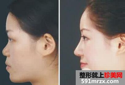 膨体隆鼻会感染吗?