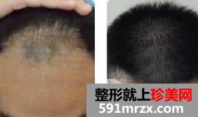 头发移植贵不贵？多少钱？