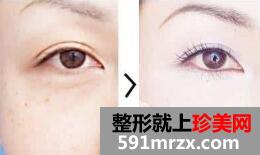 睫毛种植过程是什么样的呢？