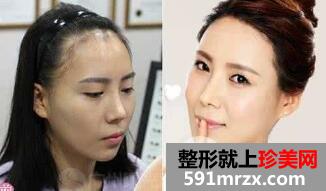 发际线种植后容易脱落吗？