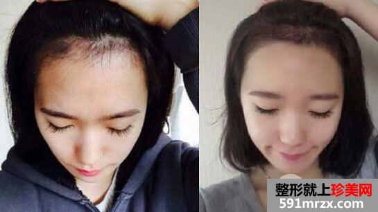 发际线种植是否容易脱落吗？
