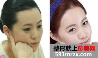 如何修饰出好看的发际线?发际线脱毛要注意哪些事项?