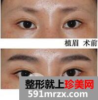 眉毛种植后还会脱落吗？