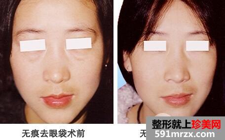 眼袋手术会留疤吗?