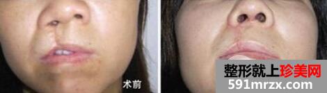成人兔唇能完全修复吗?多少钱？
