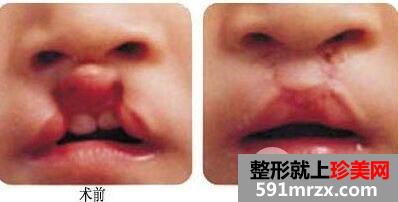 兔唇修复的最佳时间是什么时候？兔唇修复要做几次？
