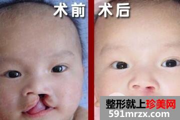 兔唇修复的最佳时间是什么时候？兔唇修复要做几次？