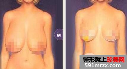 巨乳缩小多少钱？效果好吗?巨乳缩小对比图