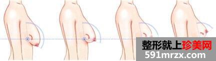 巨乳缩小手术后遗症有哪些?多少钱? 巨乳缩小效果图