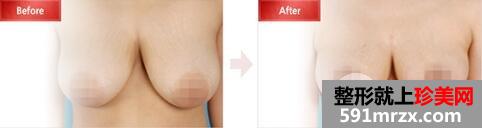 巨乳缩小多少钱？效果好吗?巨乳缩小对比图