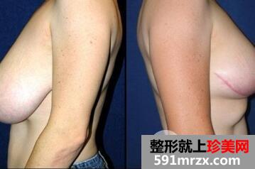 巨乳缩小手术后遗症有哪些?多少钱? 巨乳缩小效果图