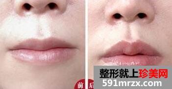 豐唇前后對比圖