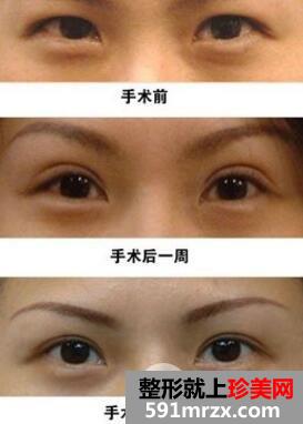 割雙眼皮恢復(fù)過(guò)程前后對(duì)比圖