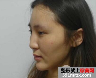 做了全脸脂肪填充效果很好一个月恢复自然真实案例对比图