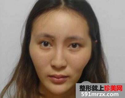 做了全脸脂肪填充效果很好一个月恢复自然真实案例对比图