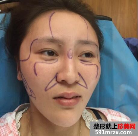 做了全脸脂肪填充效果很好一个月恢复自然真实案例对比图
